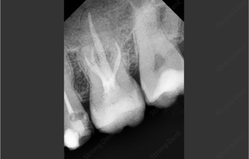 Лечение зуба под микроскопом в нижнем новгороде