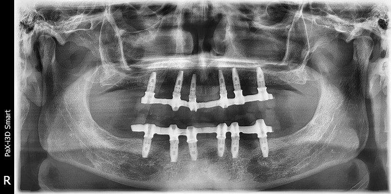 Имплантация зубов при полной потере зубов