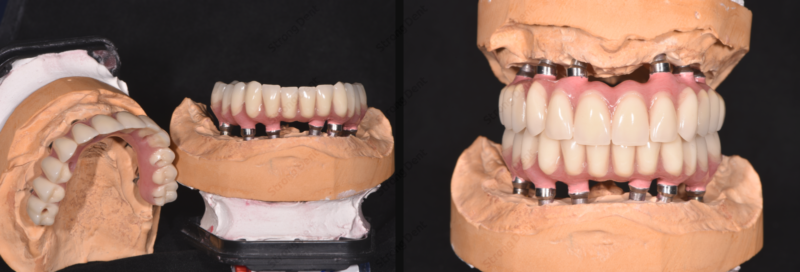 Имплантация зубов при полной потере зубов