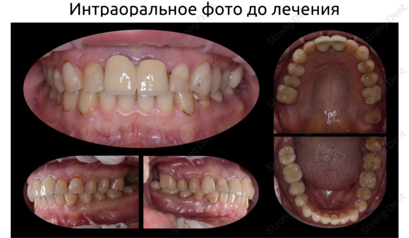 Тотальная реконструкция улыбки с протезированием на имплантах безметалловыми короноками и винирами
