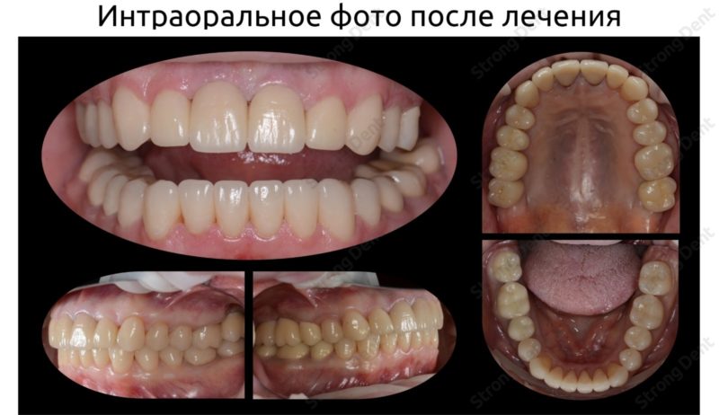Тотальная реконструкция улыбки с протезированием на имплантах безметалловыми короноками и винирами
